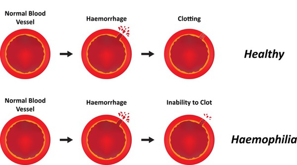 World Haemophilia Day is being observed on April 17, 2019