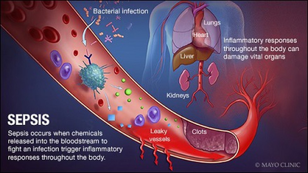 what was sepsis called during the vietnam war