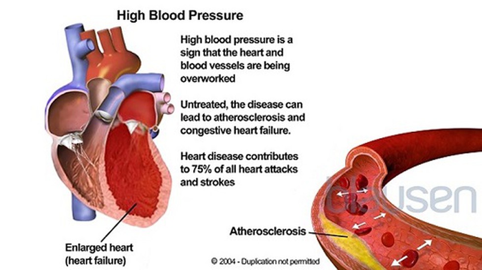 A project called the India Hypertension Control Initiative (IHCI) finds ...