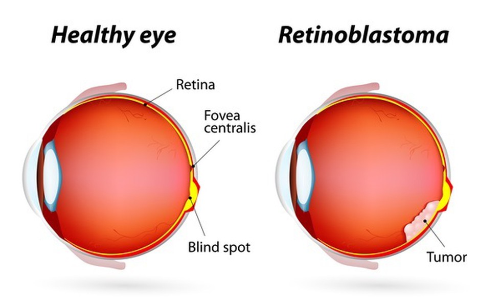 Retinoblastoma Awareness Week 2024 - Alica Frances