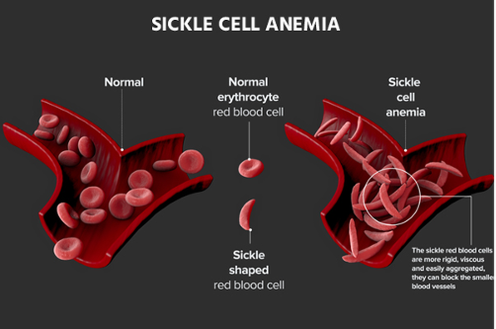 what-is-sickle-cell-anaemia-facts-yourgenome